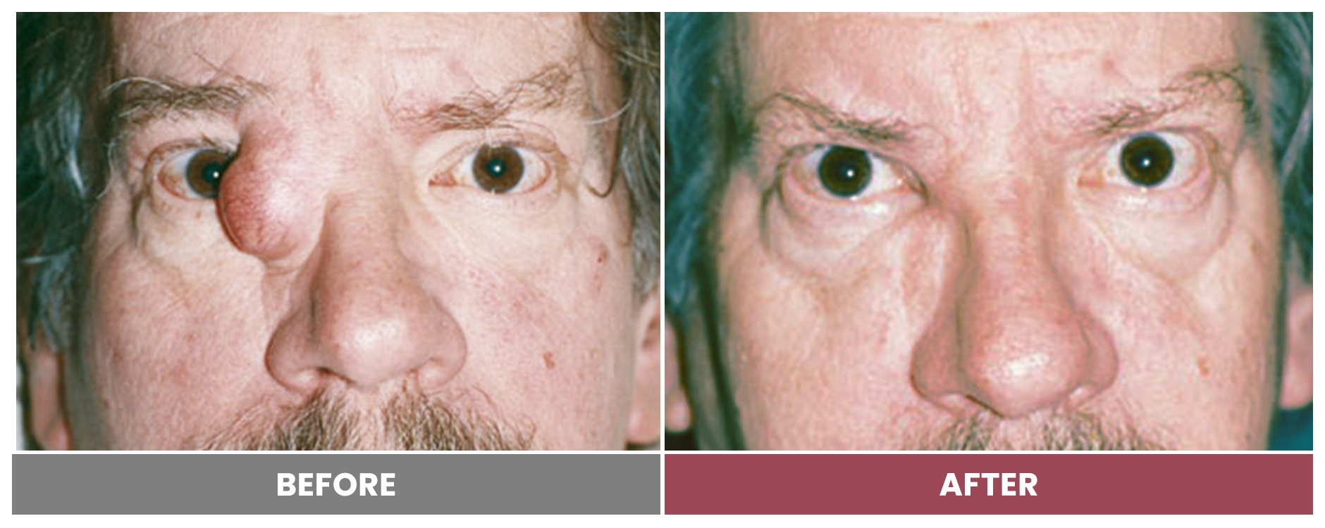 TUMOR REMOVAL AND RECONSTRUCTION - Case 3